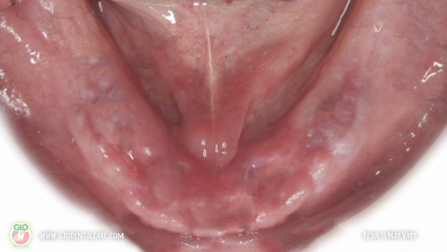 gio-dental-implants--implan-gigi